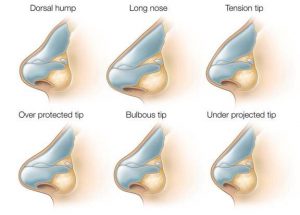 Rhinoplasty